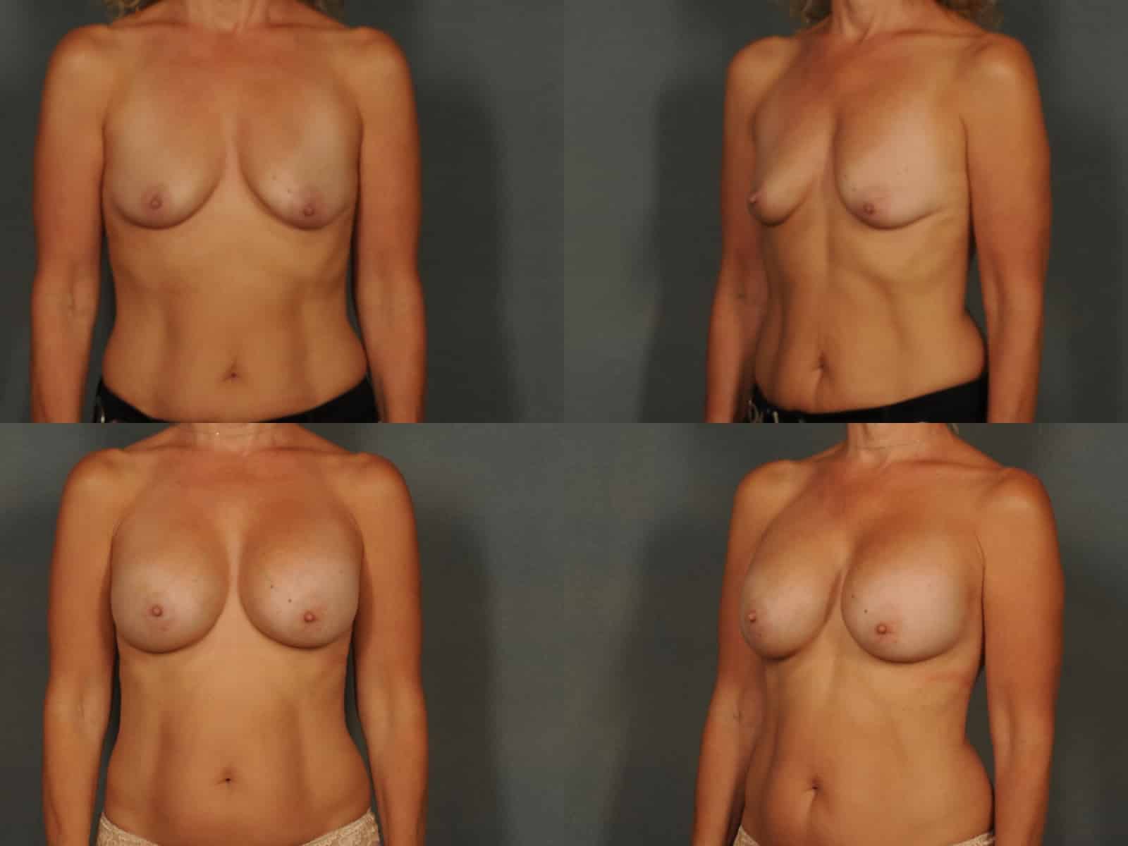 Breast Augmentation Case# 839 Combined Image