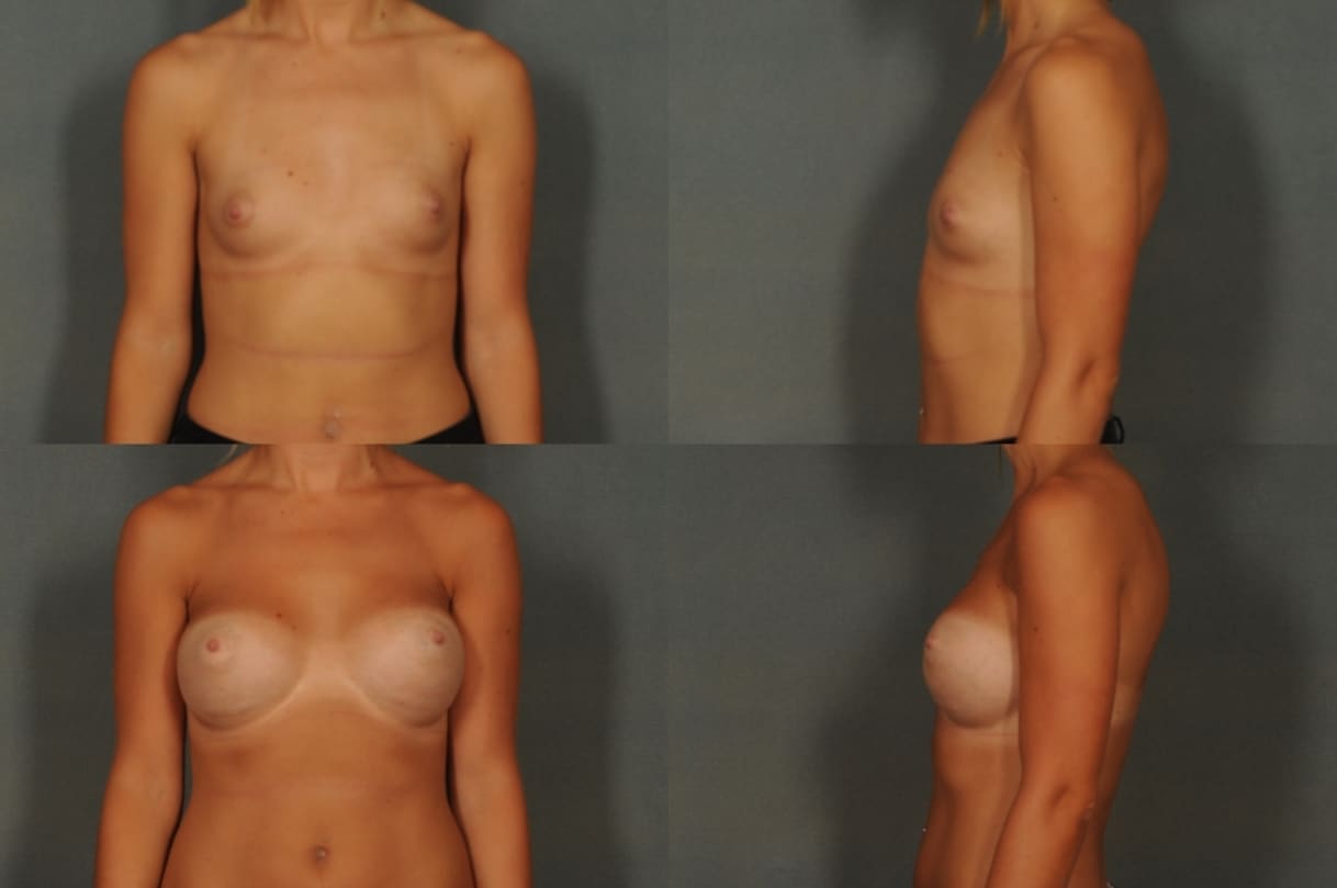 Breast Augmentation Case# 840 Combined Image