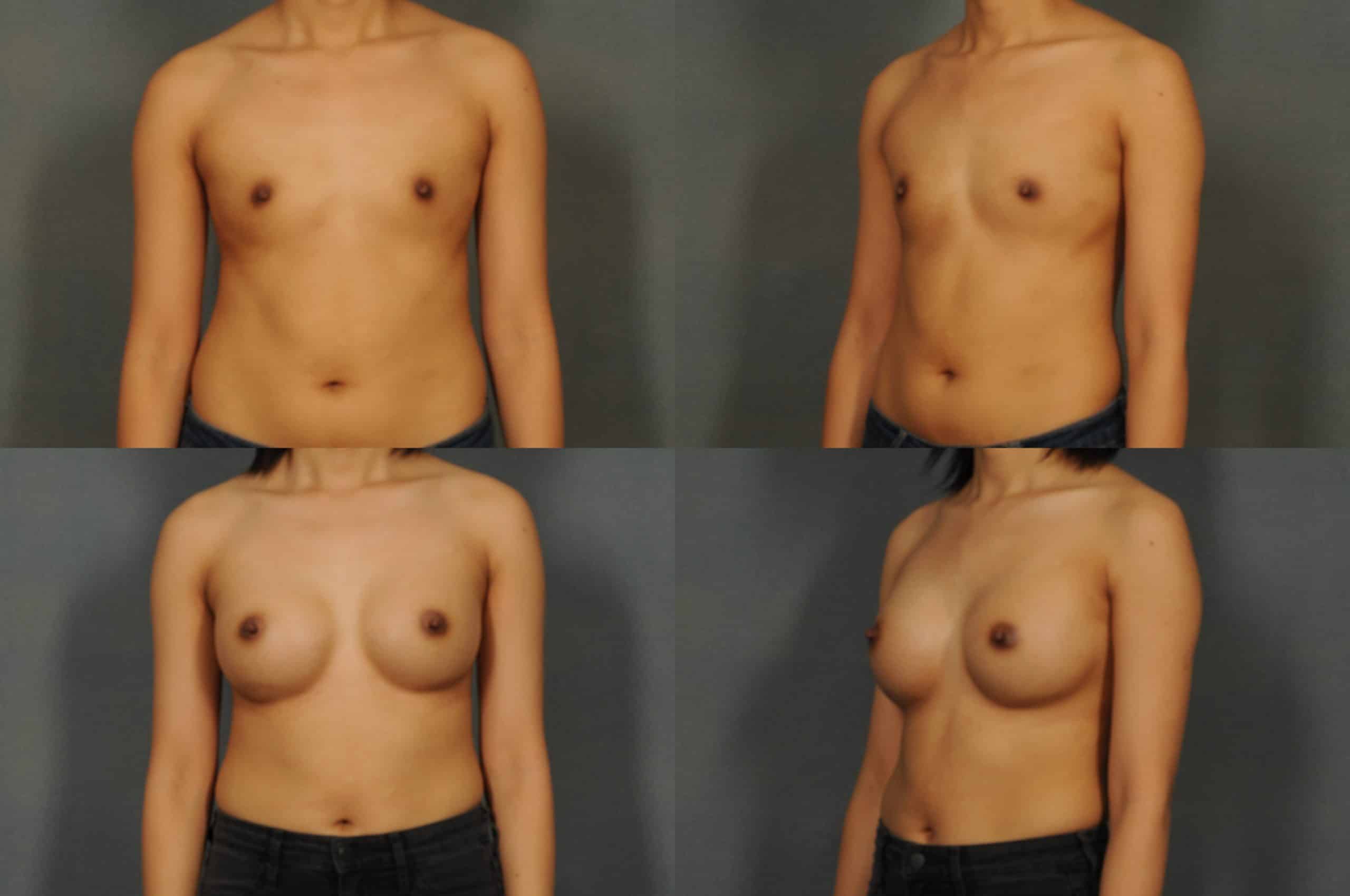 Breast Augmentation Case# 860 Combined Image
