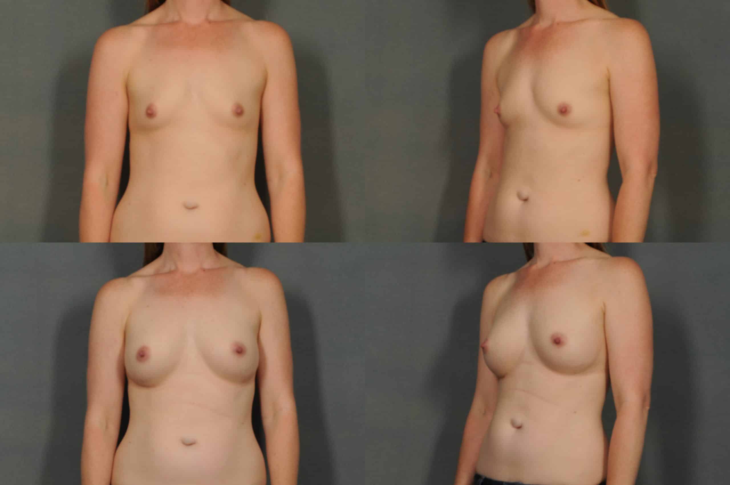 Breast Augmentation Case# 862 Combined Image