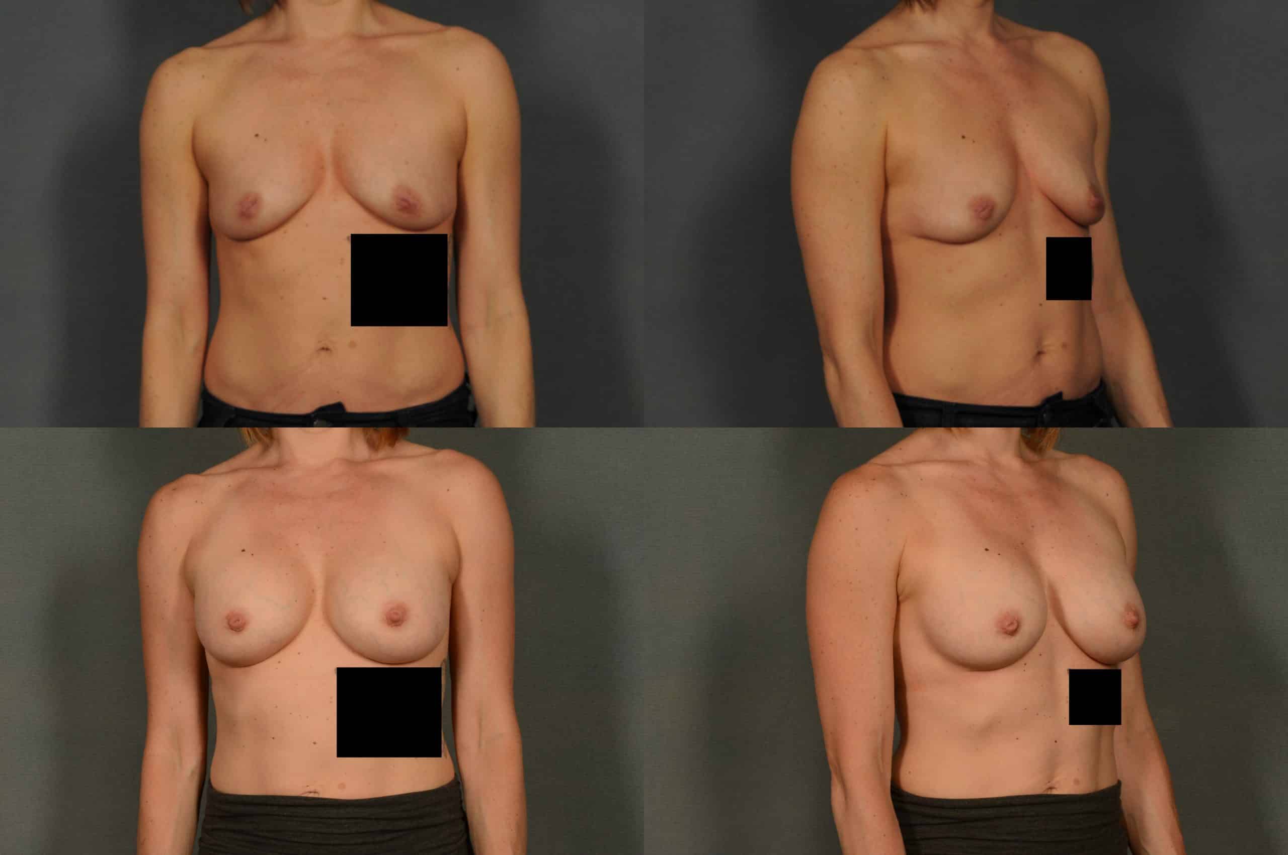Breast Augmentation Case# 910 Combined Image