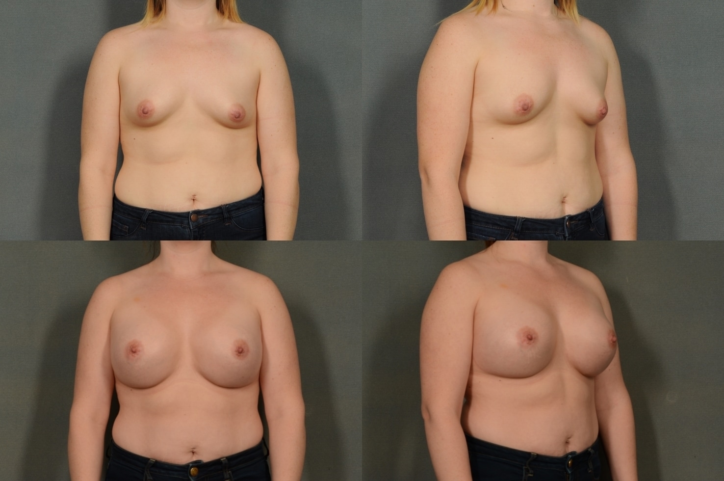 Breast Augmentation Case# 950 Combined Image