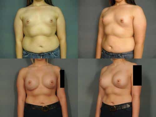 Breast Augmentation Case #961 Combined Image
