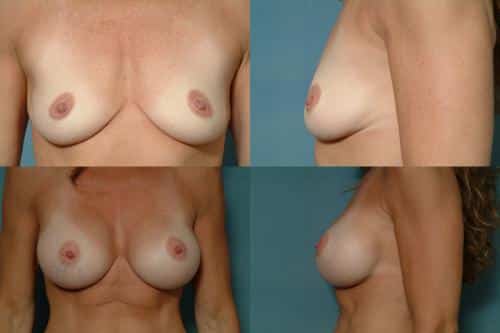 Breast Augmentation case#117 Combined Image