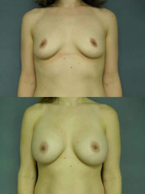 Breast Augmentation case#481 Combined Image