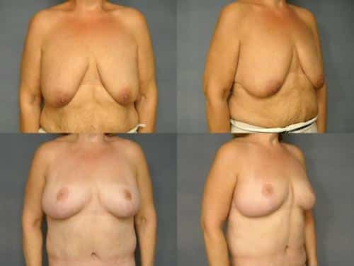Breast Auto-Augmentation Case #246 Combined Image