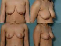 Breast Lift Case #123 Combined Image