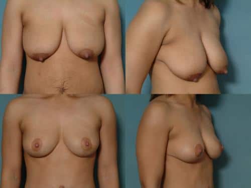 Breast Lift Case #123 Combined Image
