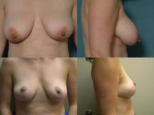 Breast Lift Case #124 Combined Image
