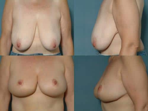 Breast Lift Case #178 Combined Image