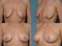 Breast Lift Case #182 Combined Image