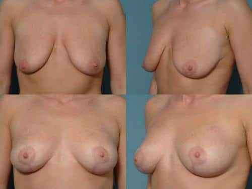Breast Lift Case #182 Combined Image