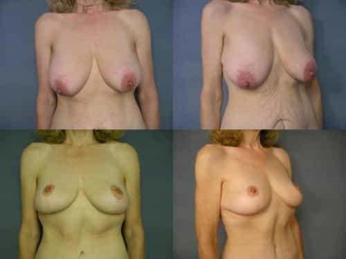 Breast Lift Case #183 Combined Image