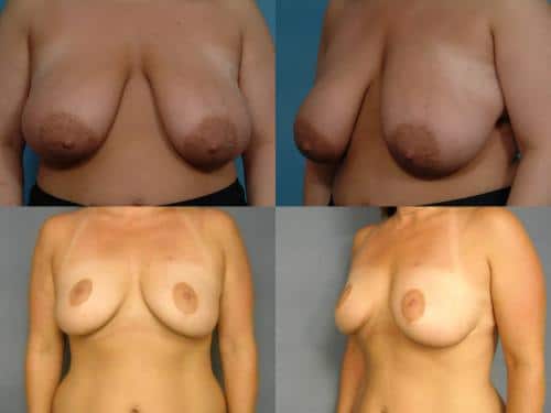 Breast Lift Case #227 Combined Image