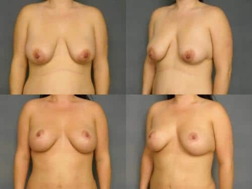 Breast Lift Case #262 Combined Image