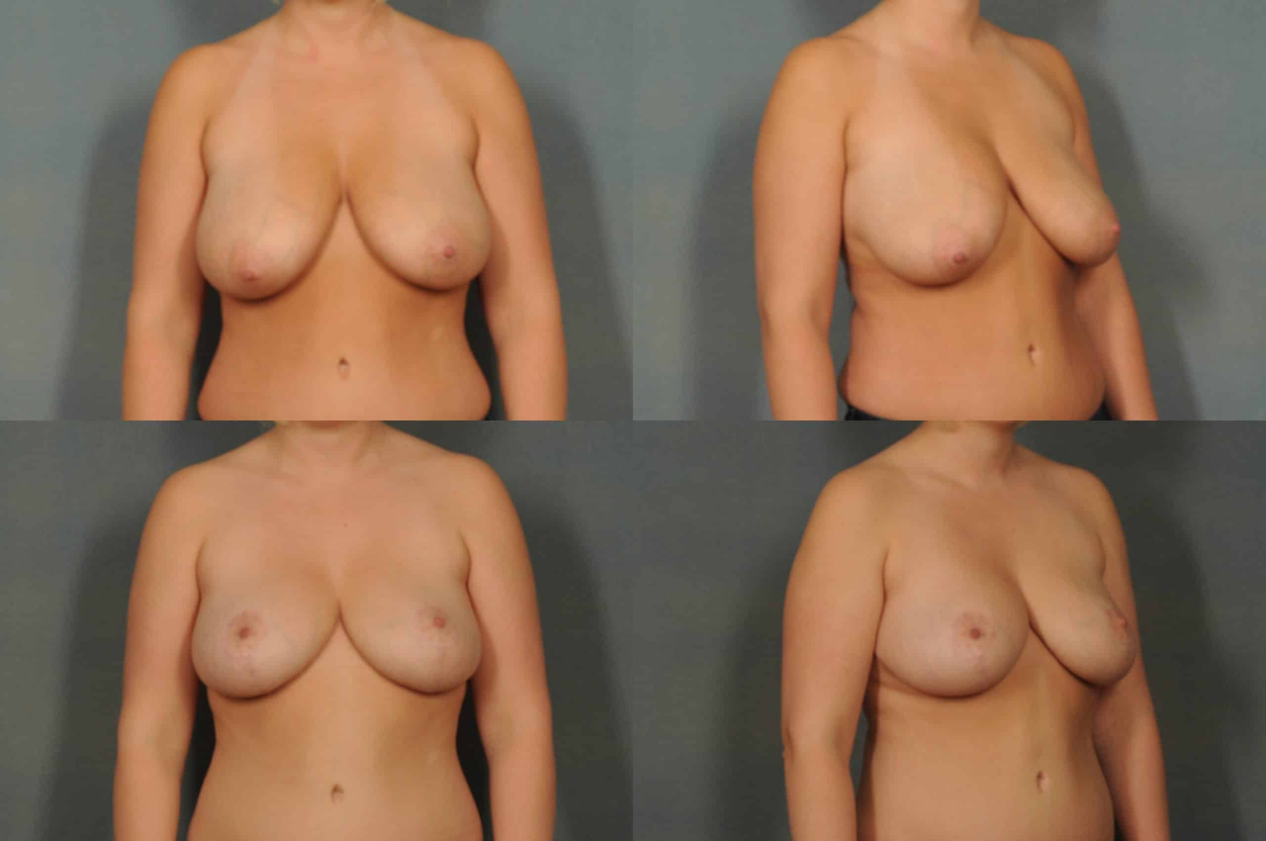 Breast Lift Case# 772 Combined Image