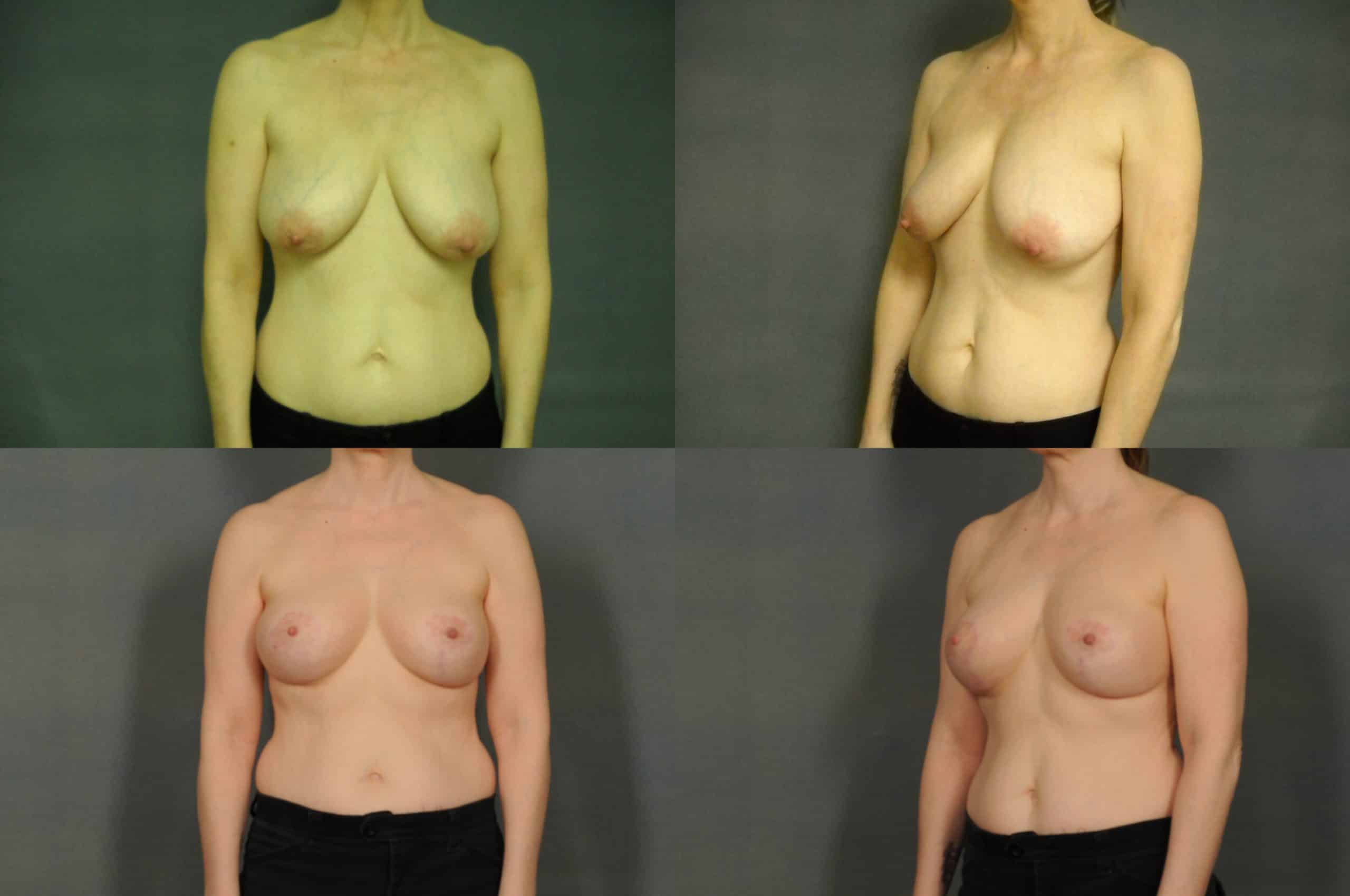 Breast Lift Case# 788 Combined Image