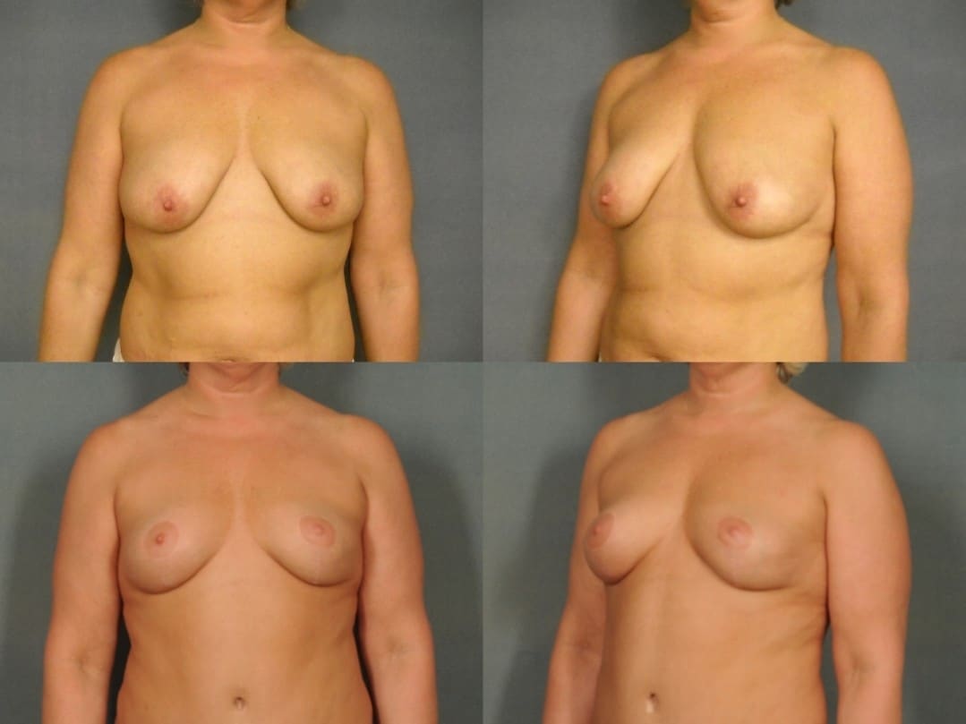 Breast Lift Case# 793 Combined Image