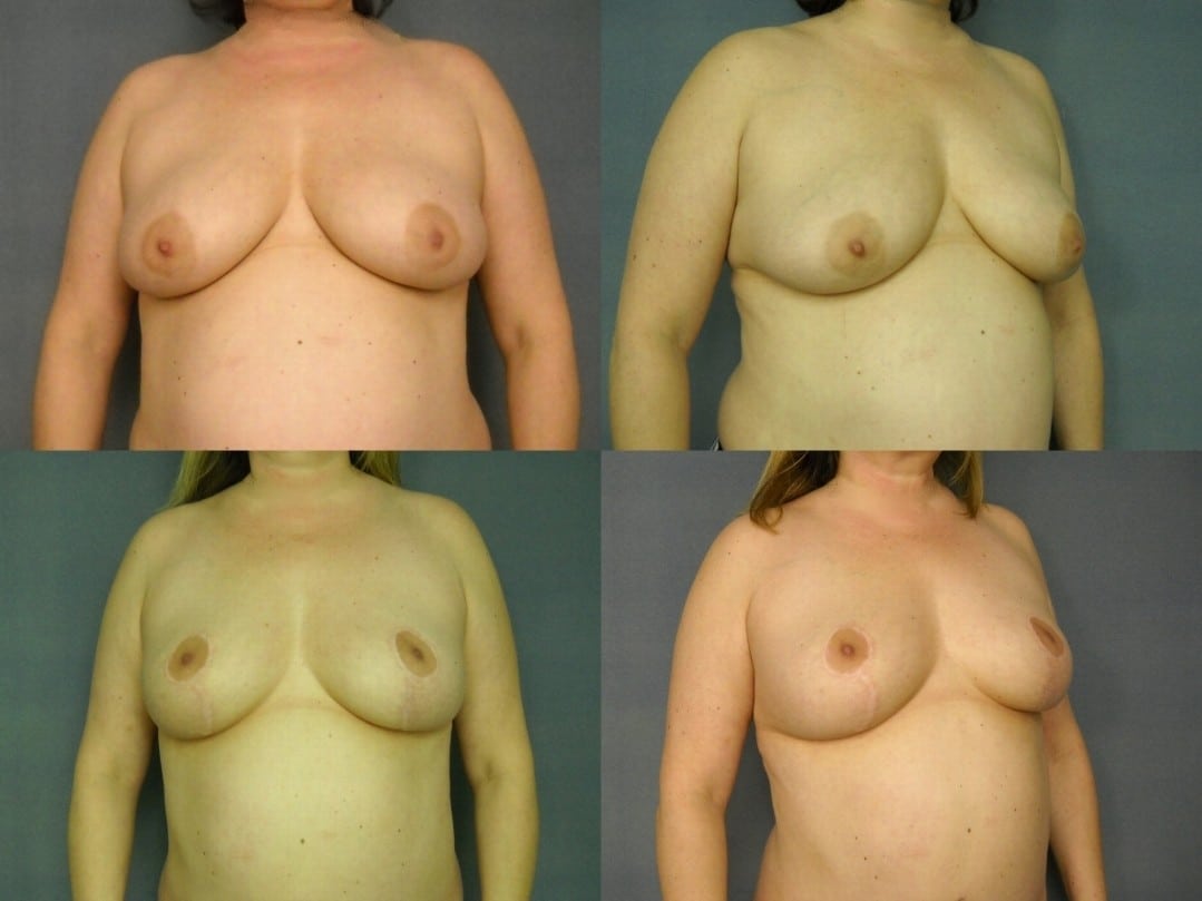 Breast Lift Case# 794 Combined Image