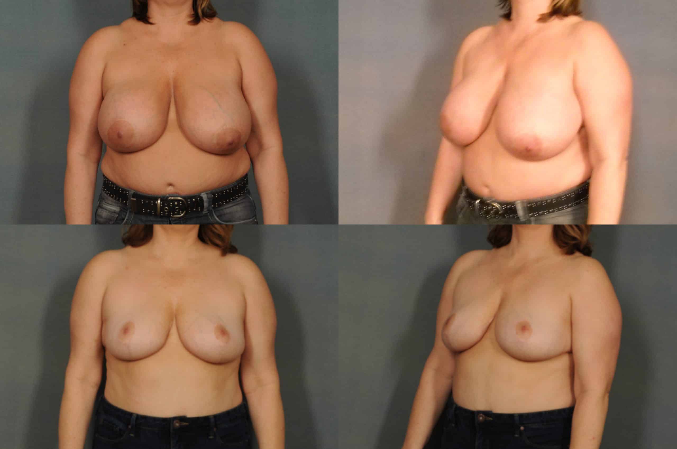 Breast Lift Case# 795 Combined Image