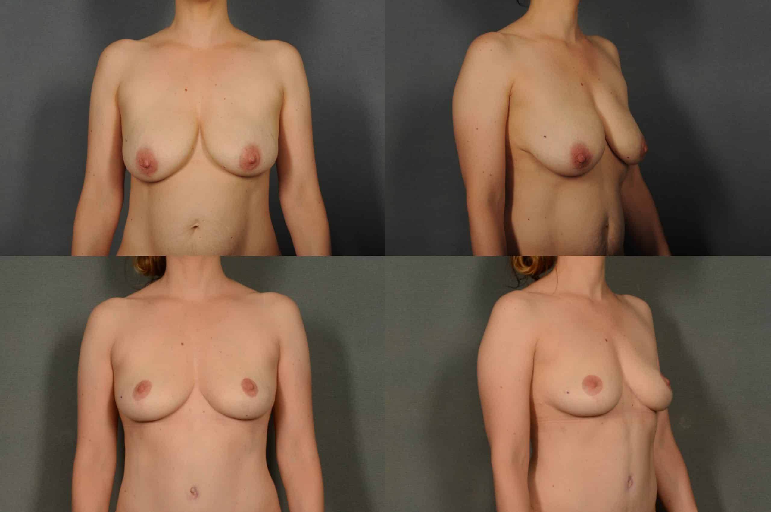 Breast Lift Case# 913 Combined Image