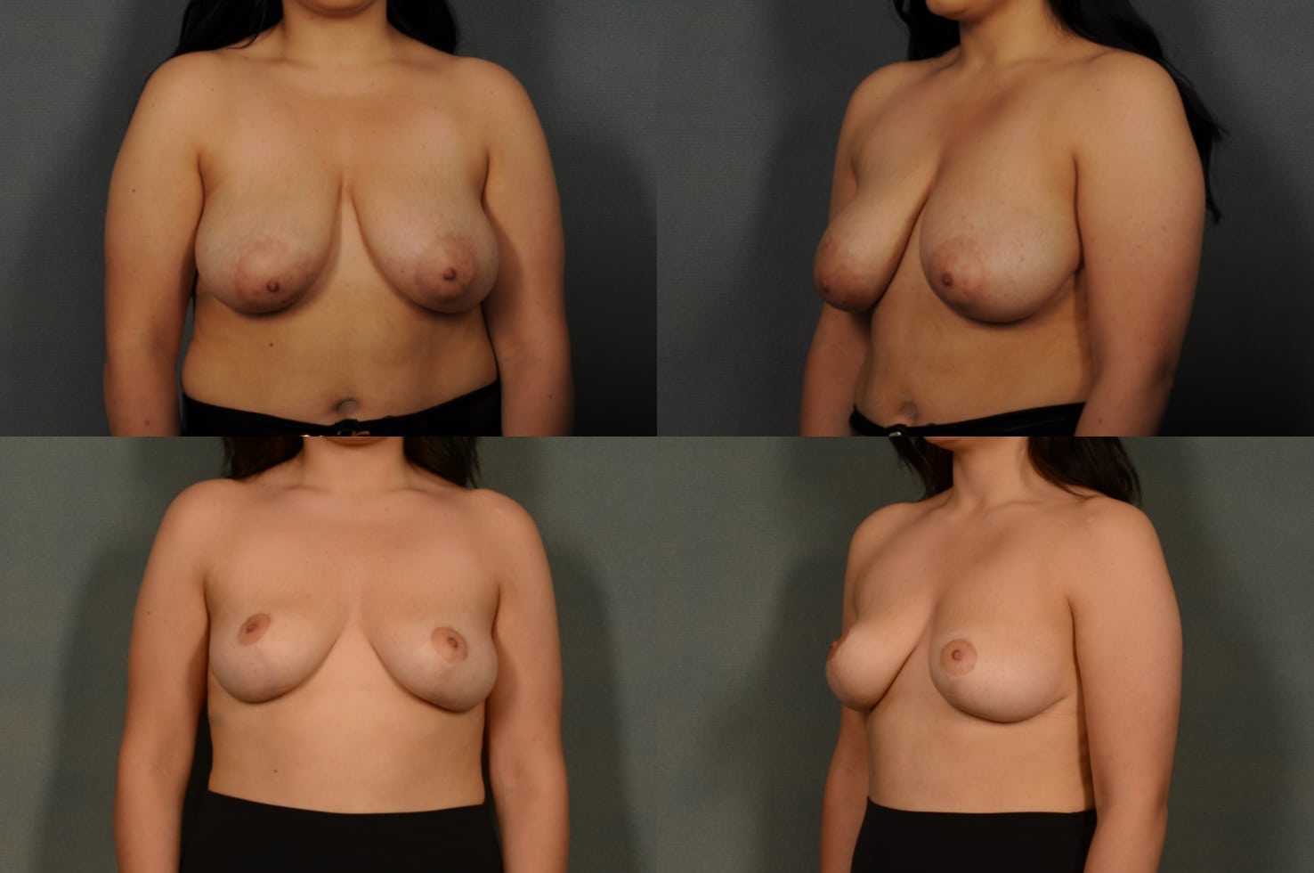 Breast Lift Case# 932 Combined Image