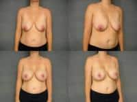 Breast Lift with Augmentation Case #293 Combined Image
