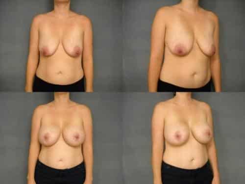Breast Lift with Augmentation Case #293 Combined Image