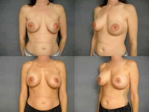 Breast Lift with Augmentation Case #681 Combined Image