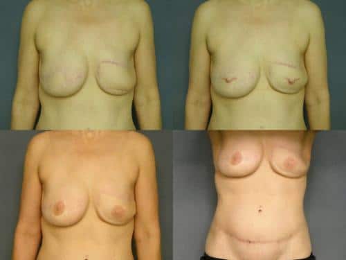 Breast Reconstruction Case #236 Combined Image