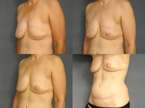 Breast Reconstruction Case #237 Combined Image