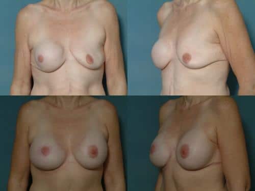 Breast Reconstruction Case #247 Combined Image