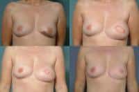 Breast Reconstruction Case #248 Combined Image