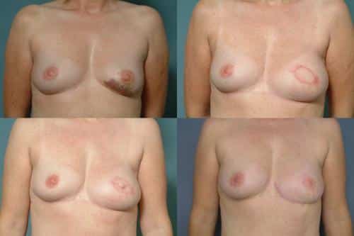 Breast Reconstruction Case #248 Combined Image