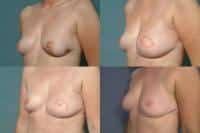 Breast Reconstruction Case #249 Combined Image
