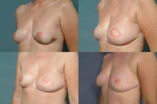 Breast Reconstruction Case #249 Combined Image
