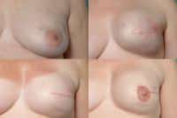 Breast Reconstruction Case #250 Combined Image