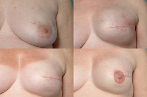 Breast Reconstruction Case #250 Combined Image