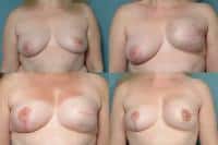 Breast Reconstruction Case #251 Combined Image