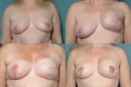 Breast Reconstruction Case #251 Combined Image