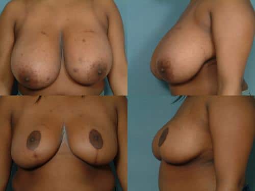 Breast Reduction Case #125 Combined Image