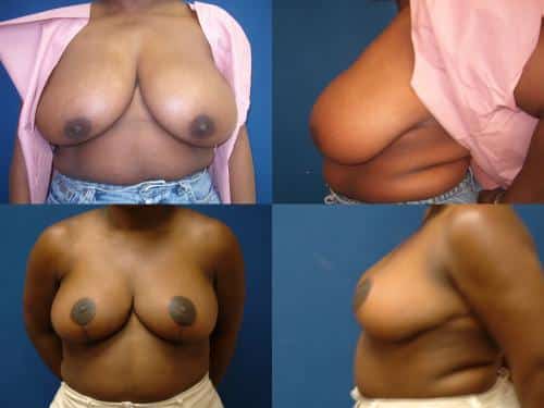 Breast Reduction Case #126 Combined Image