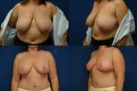Breast Reduction Case #127 Combined Image