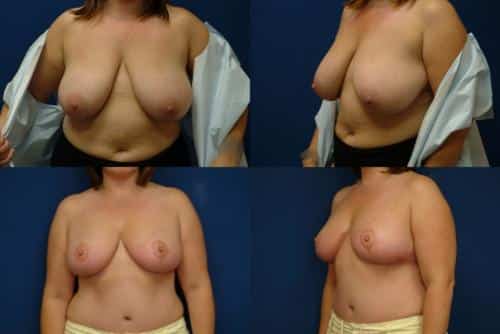 Breast Reduction Case #127 Combined Image