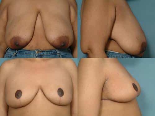 Breast Reduction Case #128 Combined Image