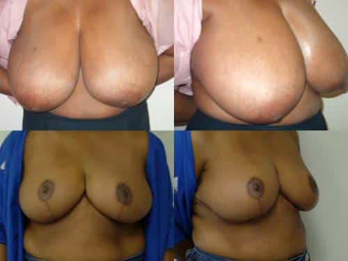 Breast Reduction Case #129 Combined Image