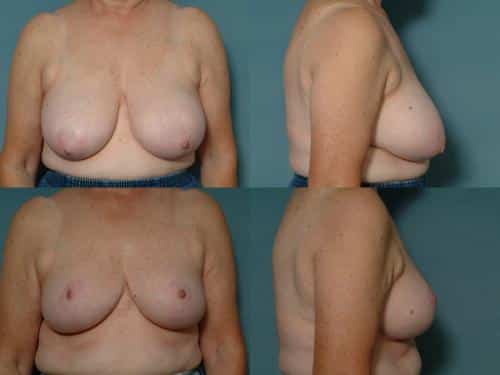 Breast Reduction Case #130 Combined Image