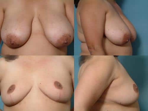 Breast Reduction Case #131 Combined Image