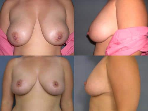 Breast Reduction Case #132 Combined Image