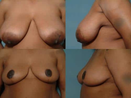 Breast Reduction Case #133 Combined Image